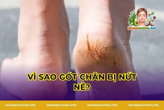 Vì Sao Gót Chân Bị Nứt Nẻ?